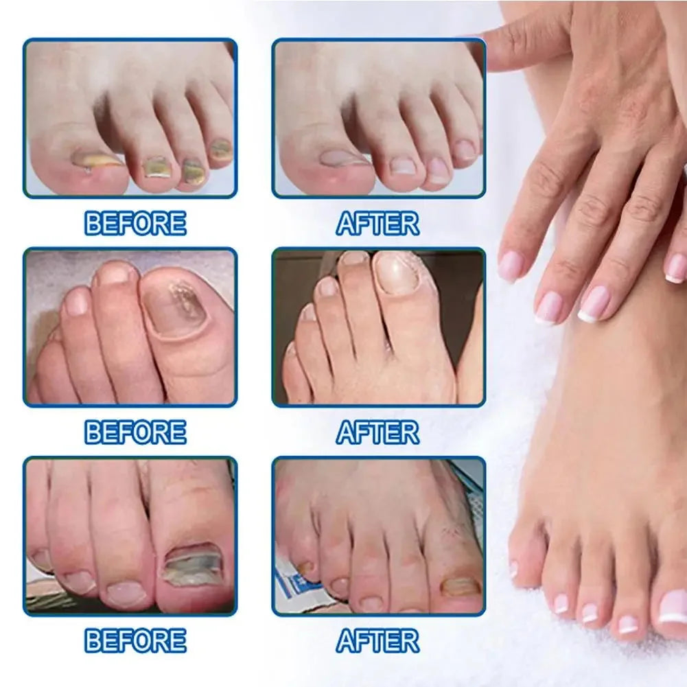 Unauffällige Reparaturpflaster für Nagelpilz — Bild 5
